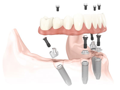 All on 4 procedure, Winnipeg Dental Implants