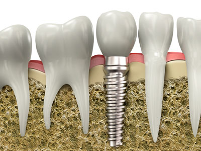 Implant Specialist Winnipeg